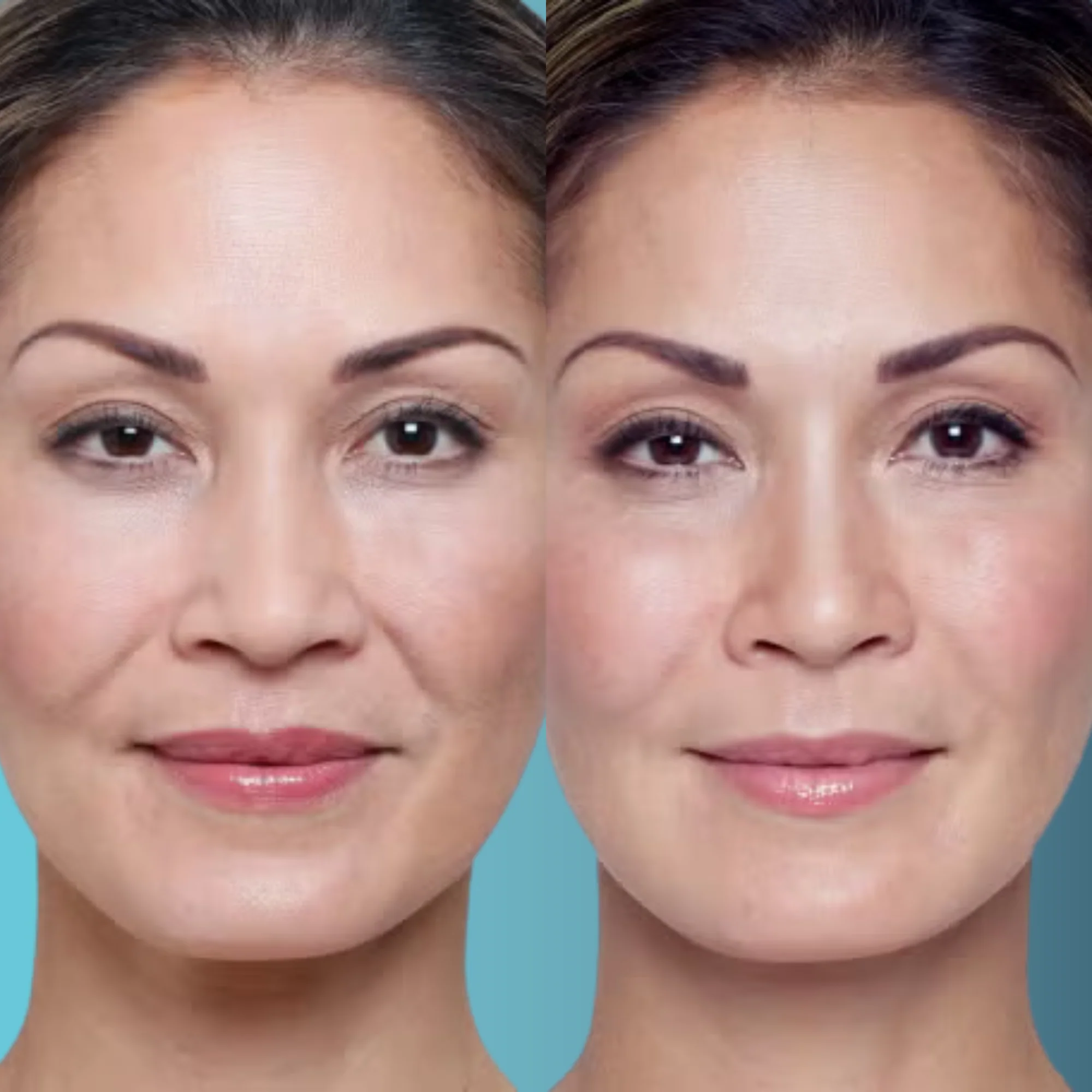 Filler acido ialuronico per volume e rughe del viso